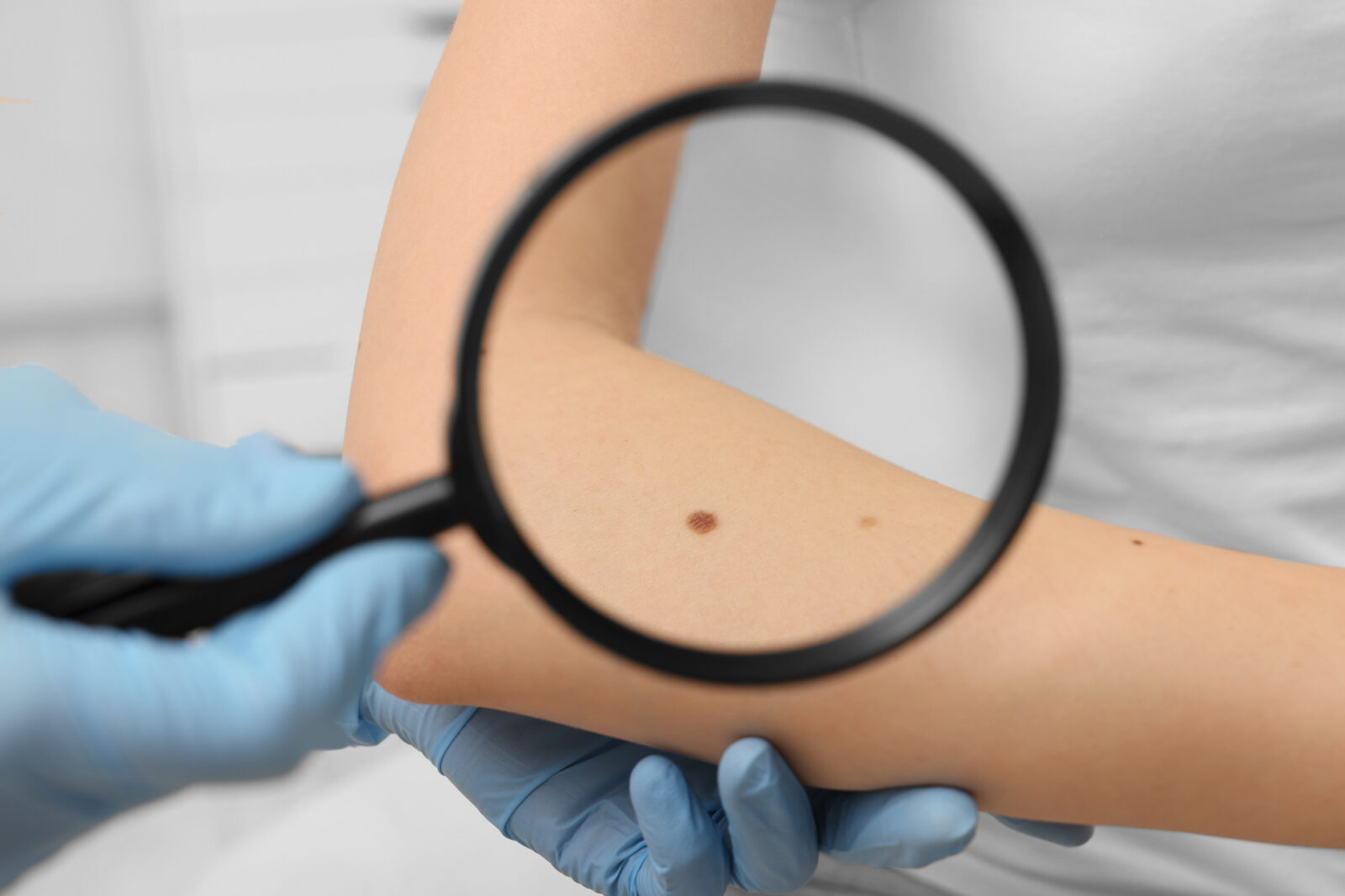Kako mi je dermatološka klinika Ljubljana pomagala odpraviti akne in mi podarila lepoto kože, ki jo samozavestno kažem svetu